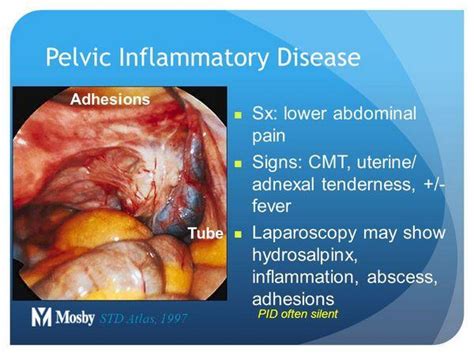 Pelvic inflammatory disease (PID)